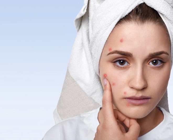 Know Why You Should Avoid Using Toothpaste On Pimple In Hindi know