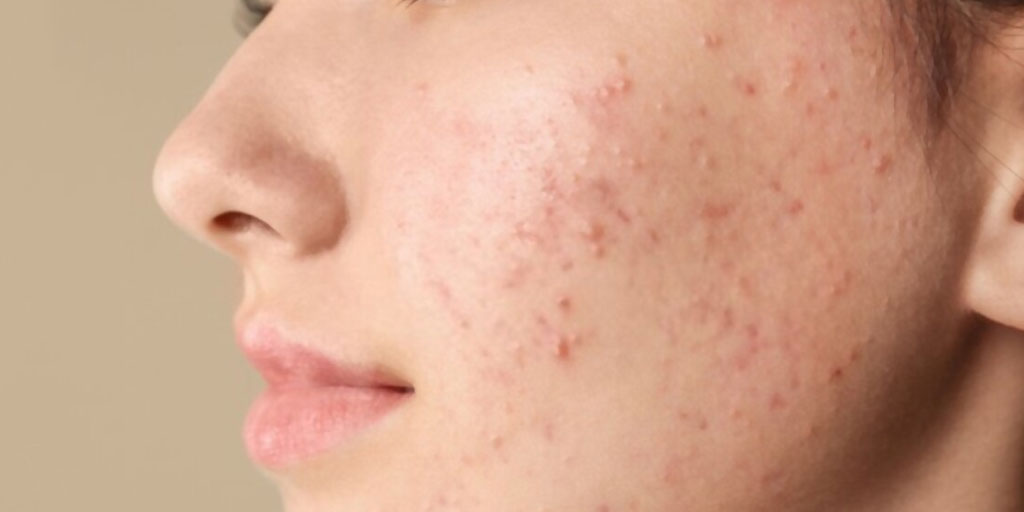 how-to-prevent-pimples-or-acne-tips-and-home-remedies-beautysutras