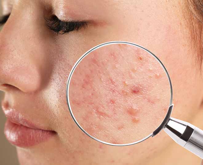 best tips to cure acne by expert 