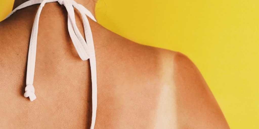 Tips On Getting Rid Of Bra Strap Tan Marks On Skin-Tips On Getting Rid Of Bra Strap Tan Marks On Skin