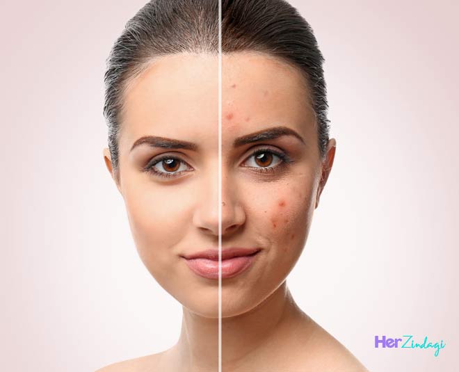 cleaning blackheads and acne