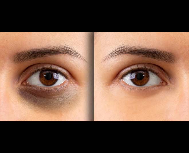 eye dark circle removal