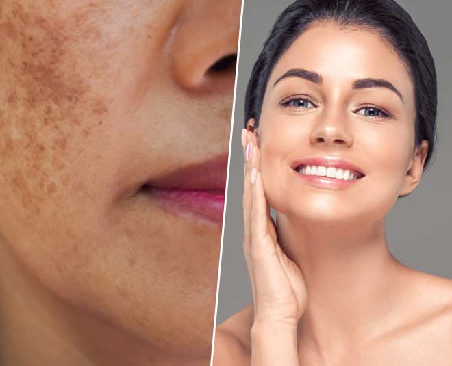 home-remedies-to-lighten-brown-dark-spots-on-face-home-remedies-to