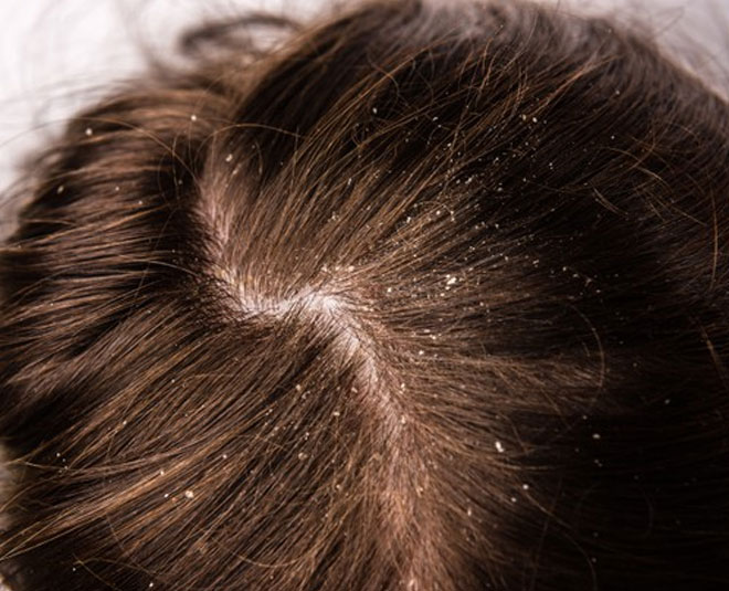 scalp dryness mehandi