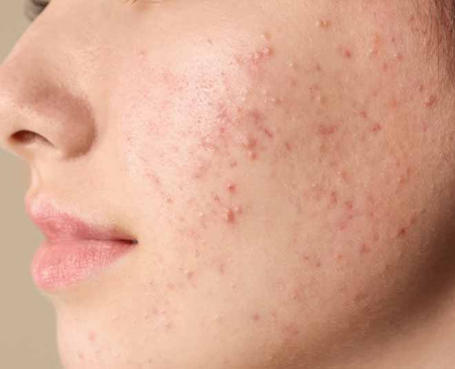 skin and acne problems