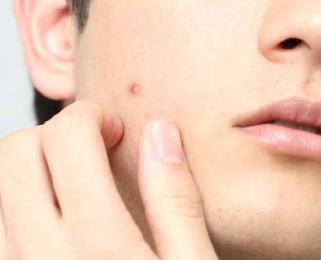 skin and acne treatment