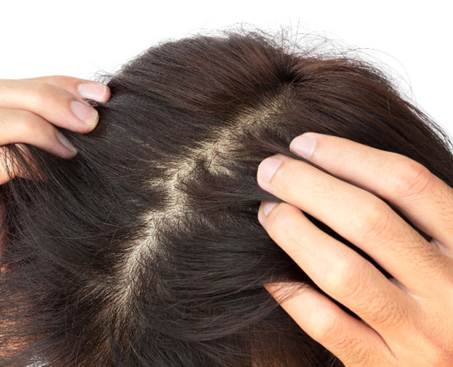 what-is-scalp-acne-best-solutions-to-get-rid-of-it-by-expert-herzindagi