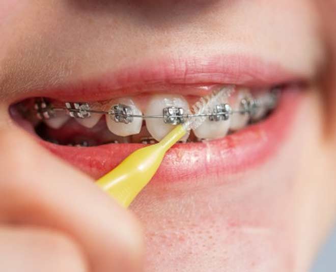 braces kids teeth