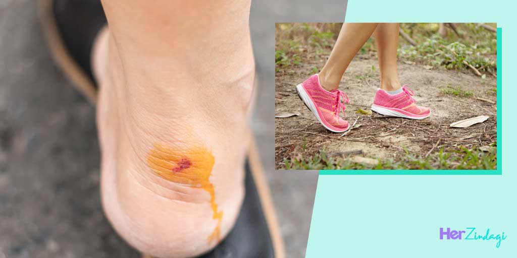 Home Remedies For Shoe Biteनए जूते या चप्पल से कट जाता है पैर तो