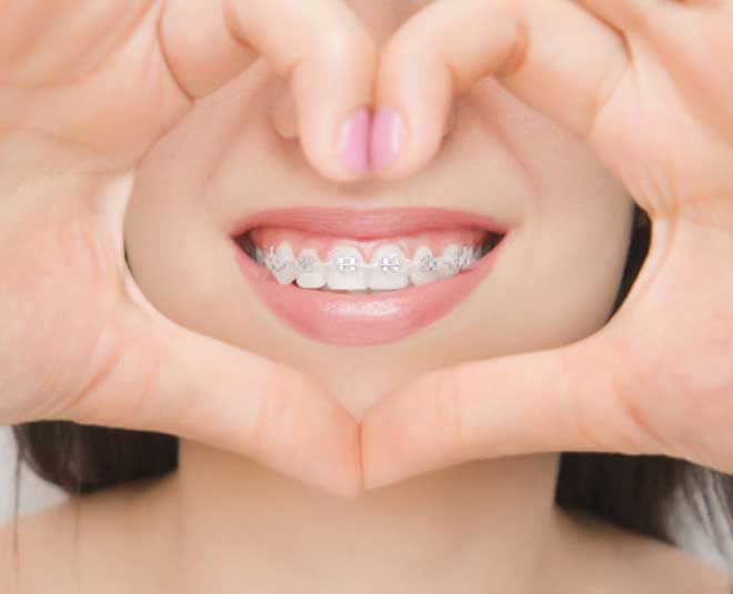 how to take care of dental braces in 