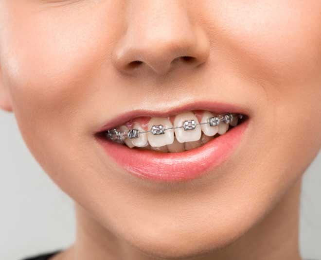 how to take care of dental braces inside 