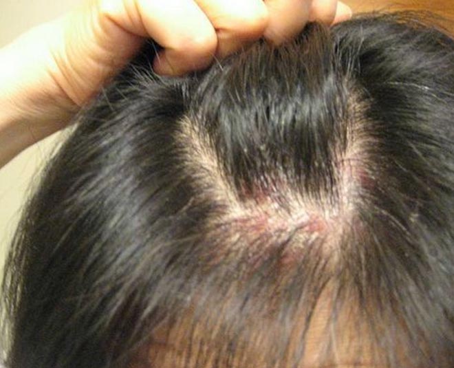Share more than 82 pimples in hair scalp latest - in.eteachers
