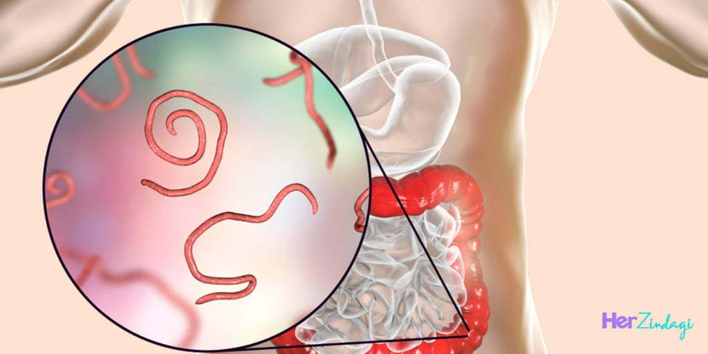 Symptoms And Home Treatment Of Threadworm थ्रेडवर्म की समस्‍या के