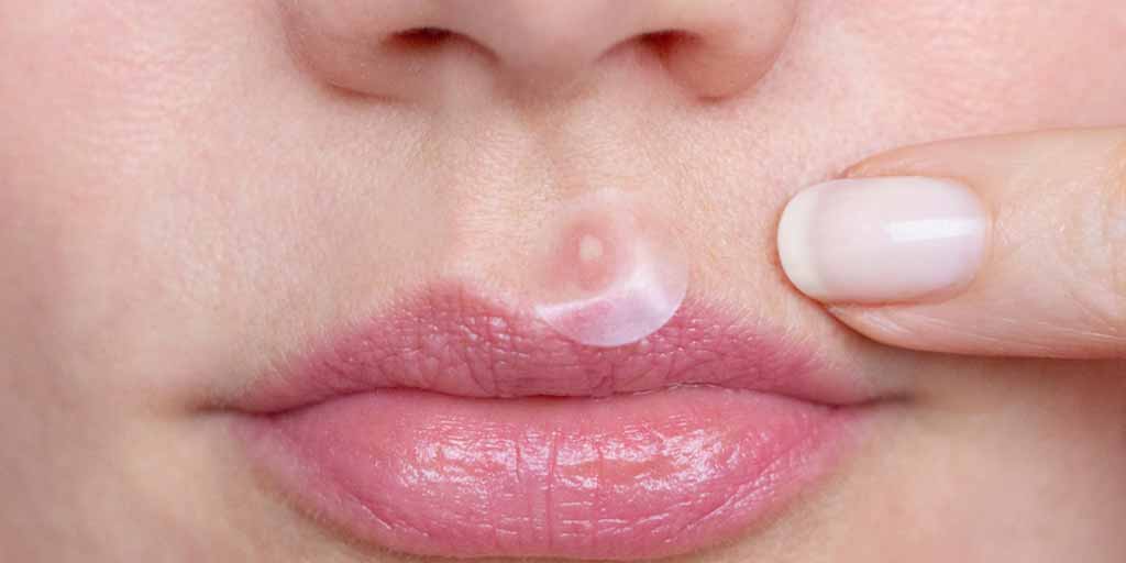 symptoms-and-home-treatment-of-boils-on-lips