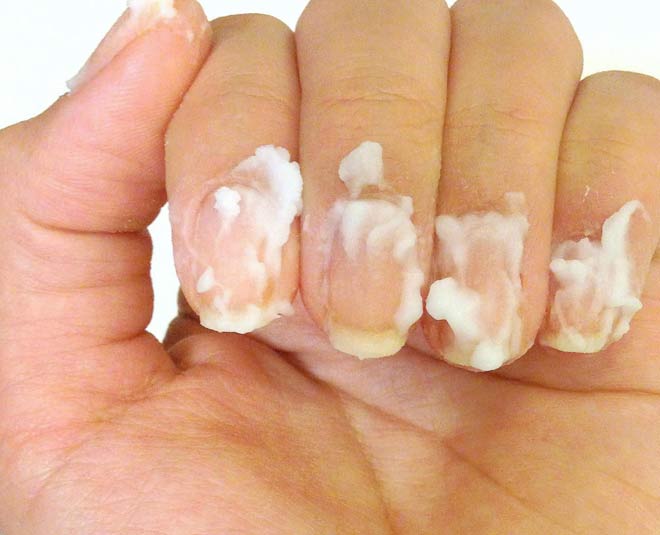 nail fungus best solution