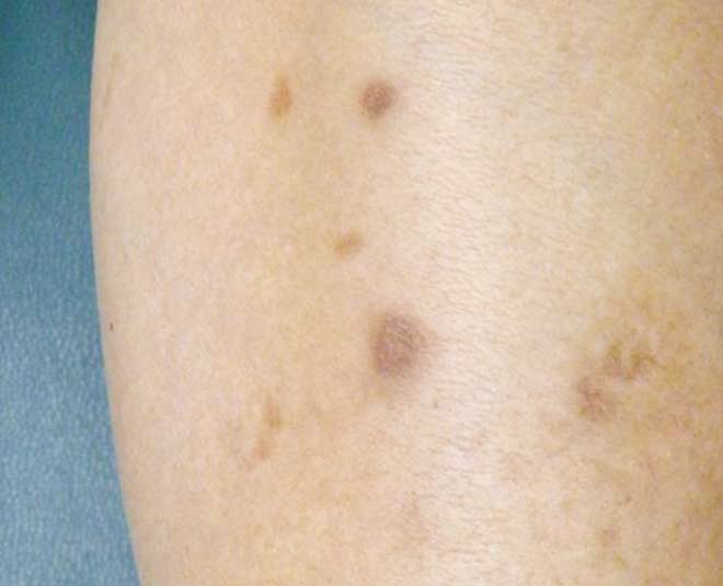 skin shin spots