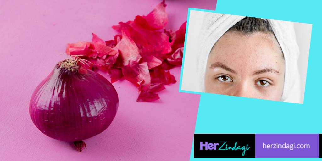 5 Ways You Can Use Onion Peels To Cure Acne & Pimples HerZindagi