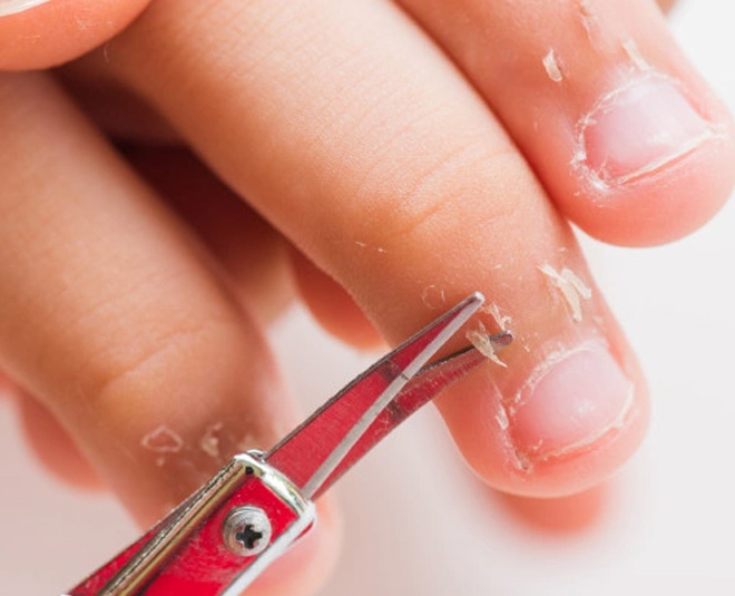 how to get rid of peeling skin around nails - YouTube