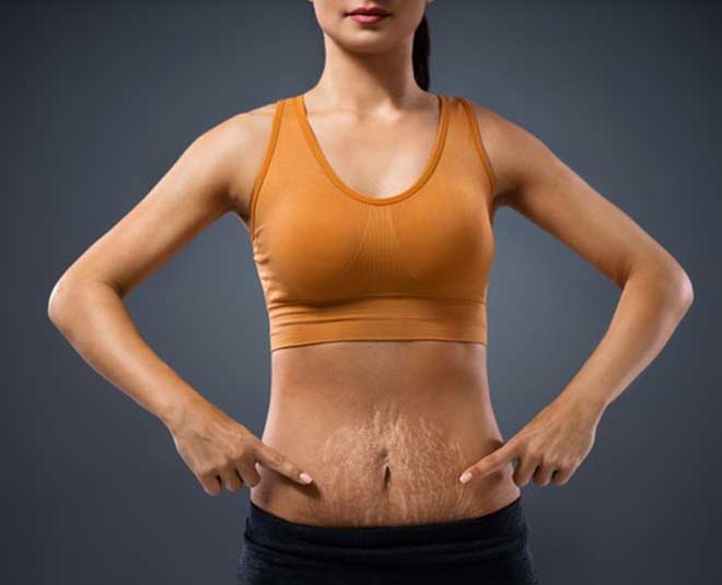 remedies  for  stretch  marks