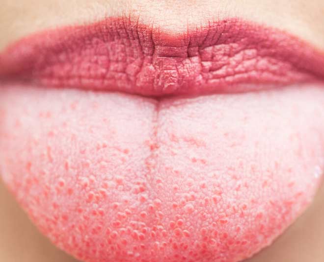 These Reasons Are Responsible For Your Tongue Turning White | HerZindagi