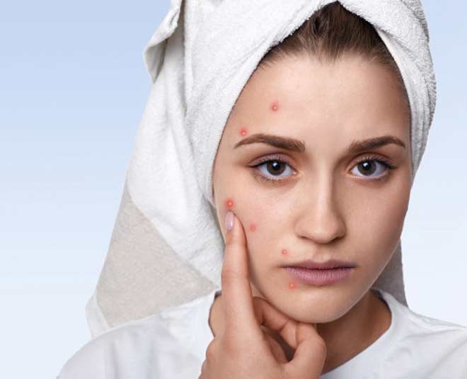 Ways To Get Rid Of Acne Fast In Hindi एक्ने की समस्या से परेशान हैं तो