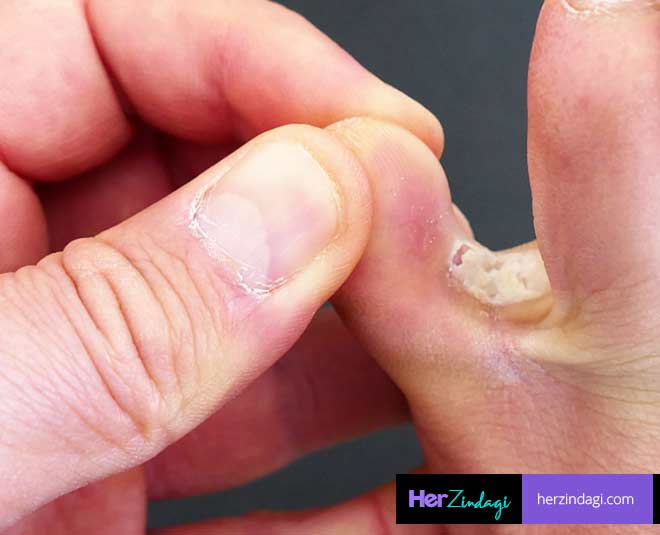 athelete foot symptoms