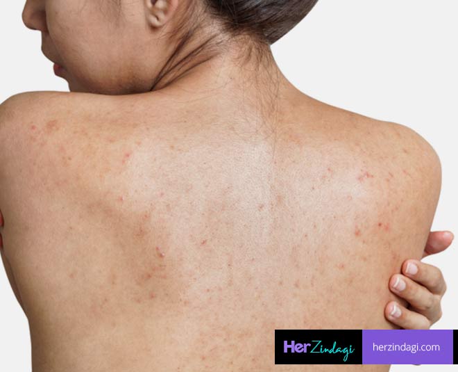 back acne and black sport