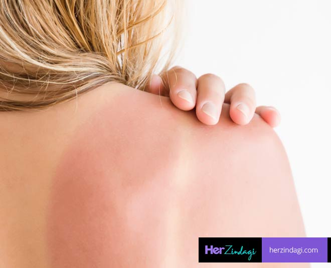 back tan and sun burn