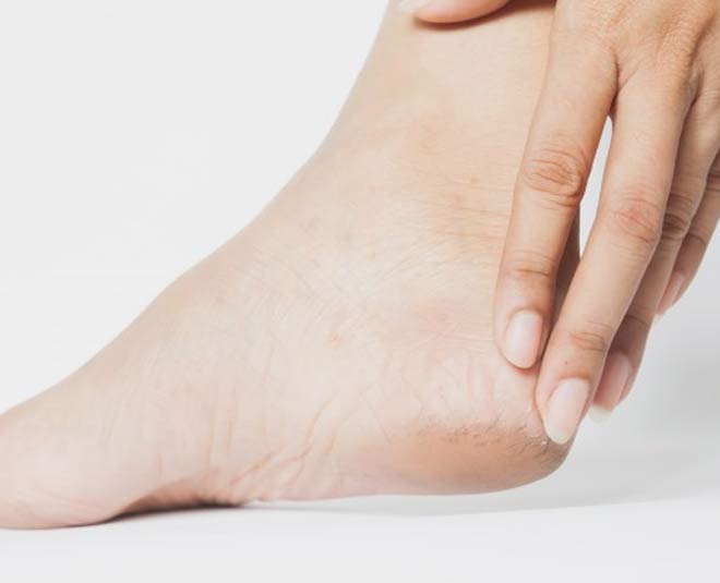 cracked heels for home