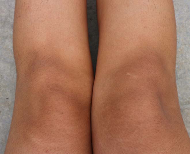 Have Dark Inner Thighs? Try These Homemade Cures, Prevent With These Tips