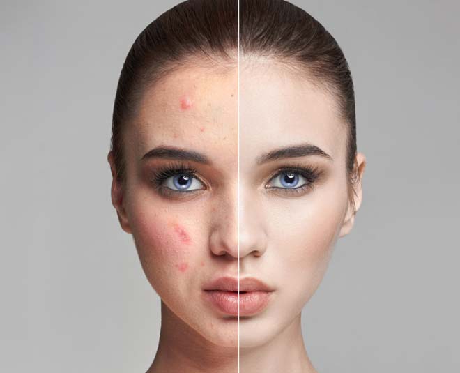 gharelu nuskhe for acne