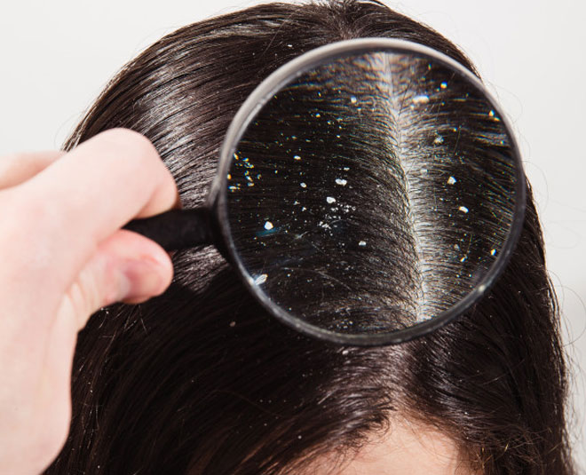inside  dandruff