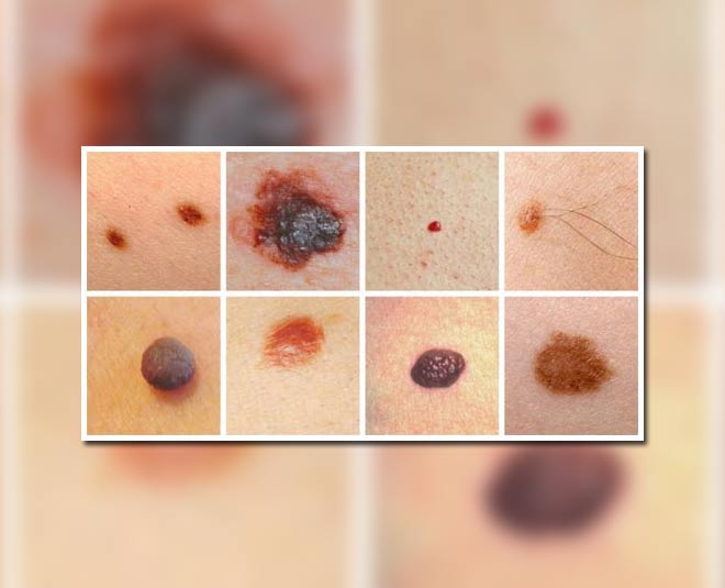 How To Know Whether Your Moles Are Malignant Or Benign Herzindagi