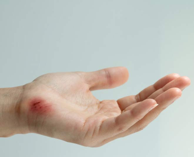 neem oil uses for wounds inside 