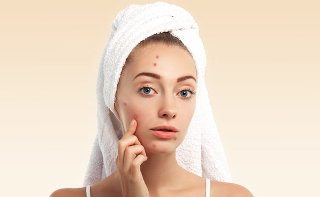 quiz on acne inside 