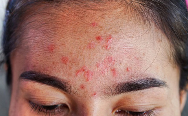 quiz on acne inside 