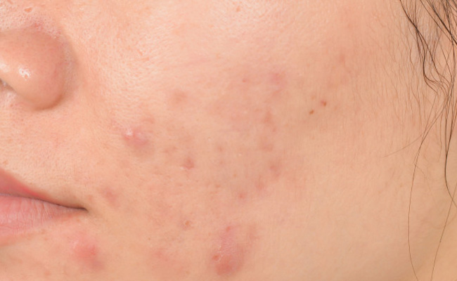 quiz on acne inside 