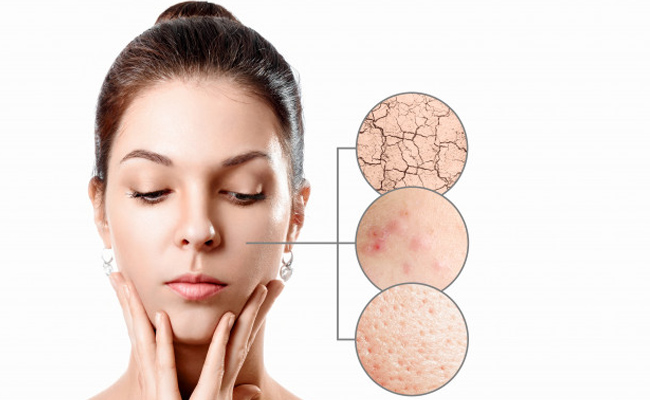 quiz on acne inside 