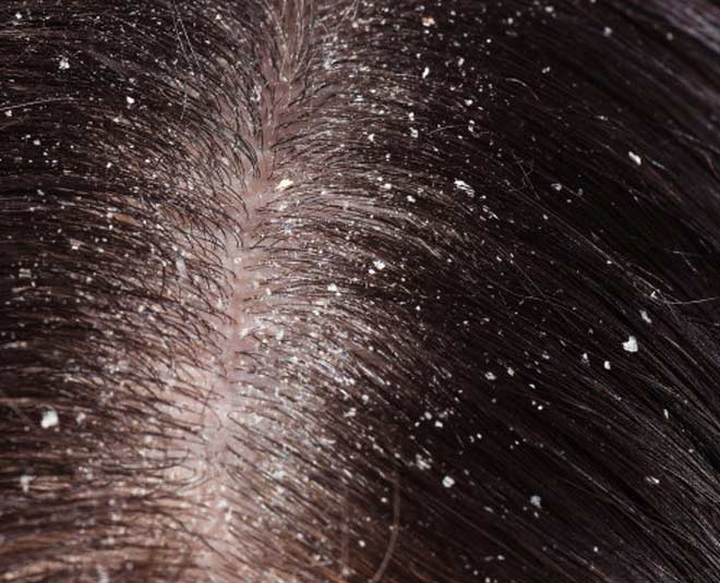 uses of honey for dandruff inside
www.worldcreativities.com