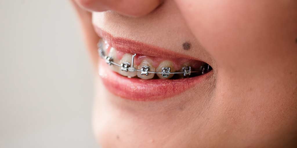 Things To Remember While Wearing Dental Braces By Expert In Hindi