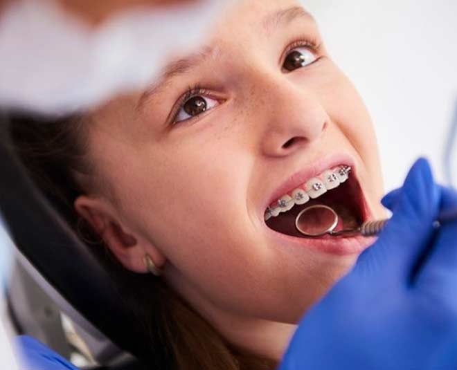 Things To Remember While Wearing Dental Braces By Expert In Hindi