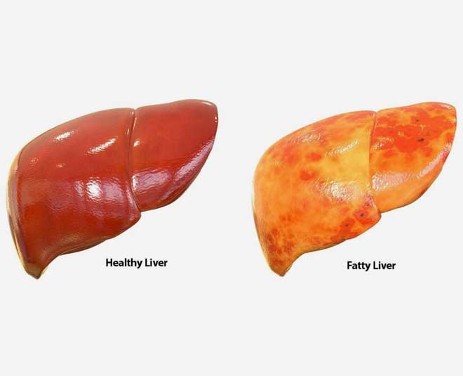 fatty liver problems