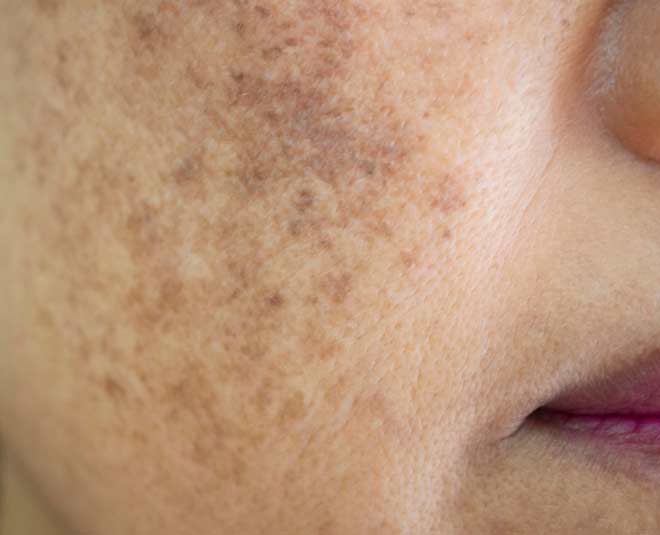 Inhibere i dag Synlig Using Retinol To Applying Sunscreen, 4 Things You Should Do To Treat Dark  Spots On Face | HerZindagi