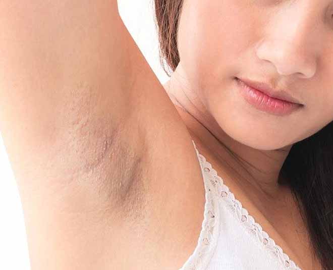 pigmentation problems with underarms