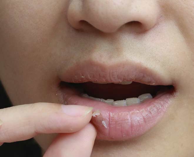 how-to-get-rid-of-peeling-dry-lips-how-to-get-rid-of-peeling-dry-lips