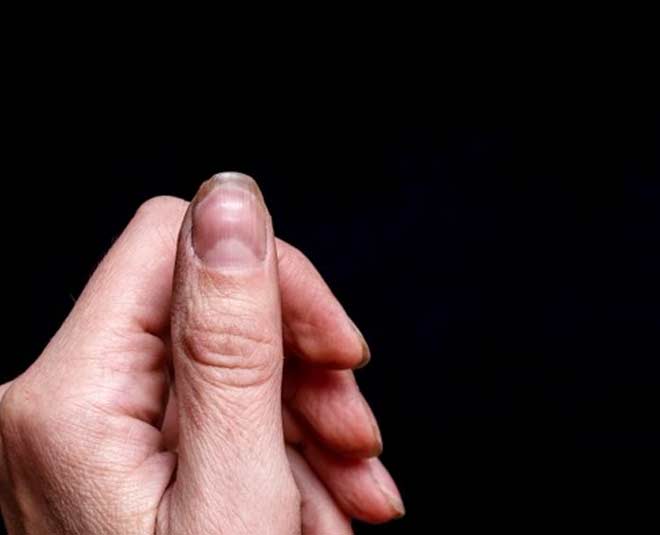 nail  diseases  symptoms