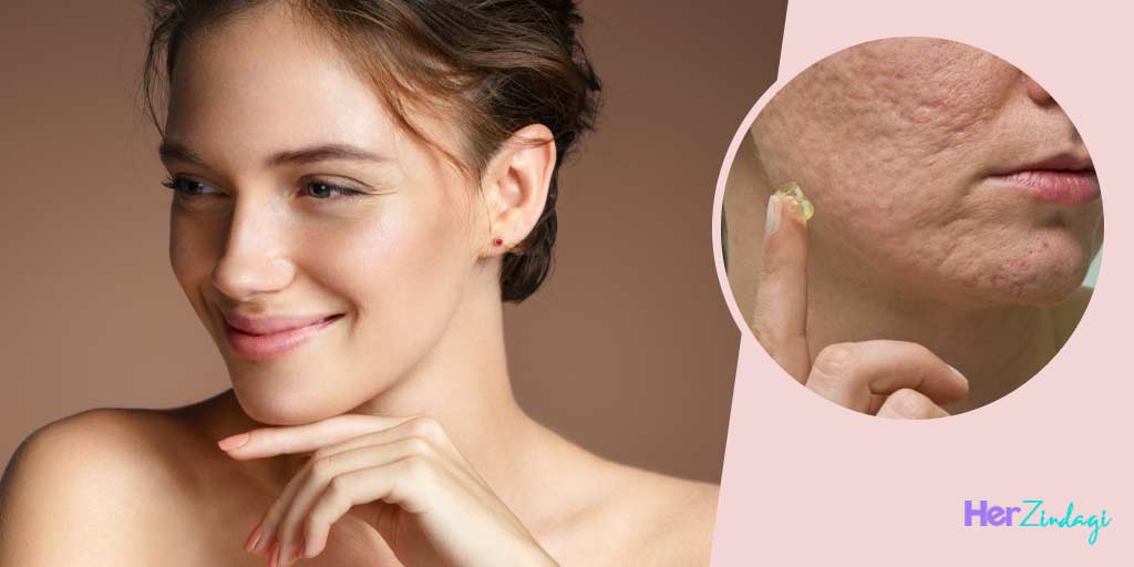 Expert Tips How to Get Rid of Pockmarksपॉकमार्क्‍स से परेशान महिलाएं