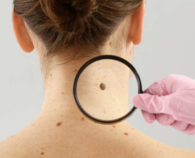 tips to remove moles on neck pic