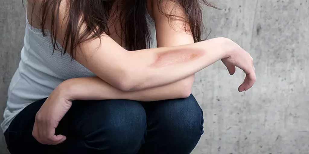 Expert Shares How To Remove Burn Scars HerZindagi