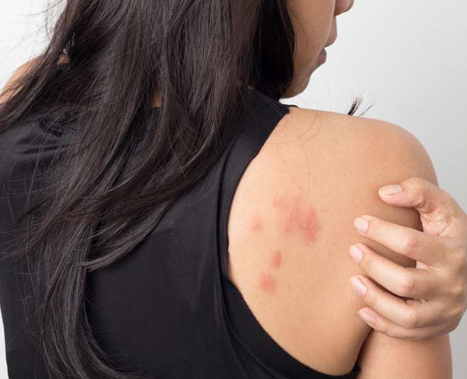 Expert Shares What To Do If You Have Hives HerZindagi